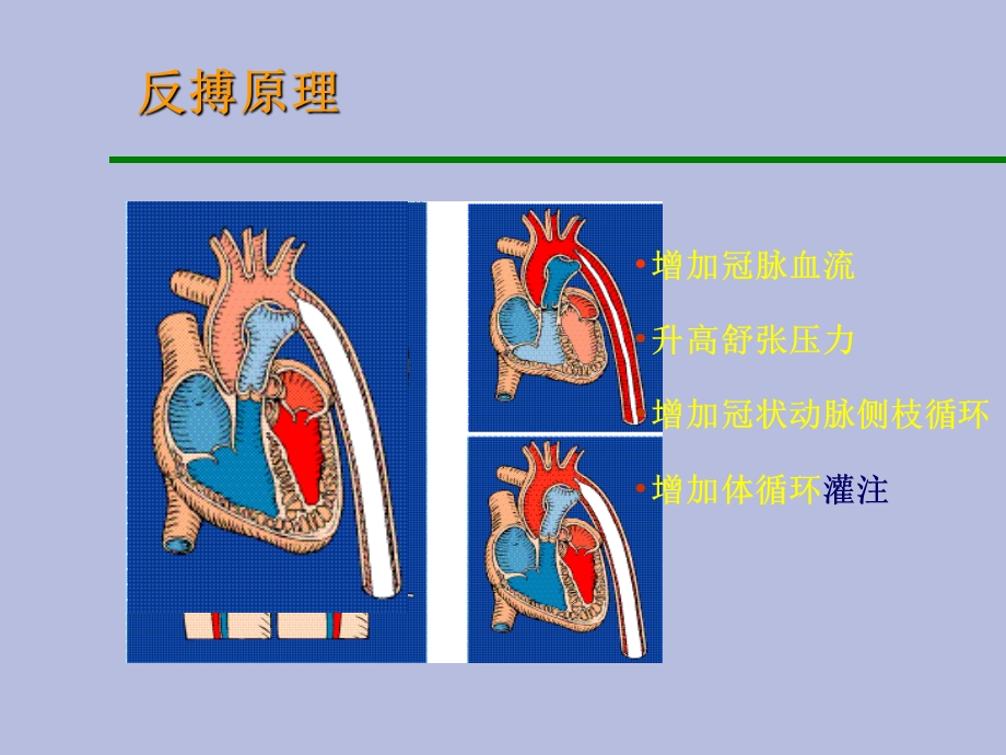 主动脉内球囊反搏泵.ppt_第3页