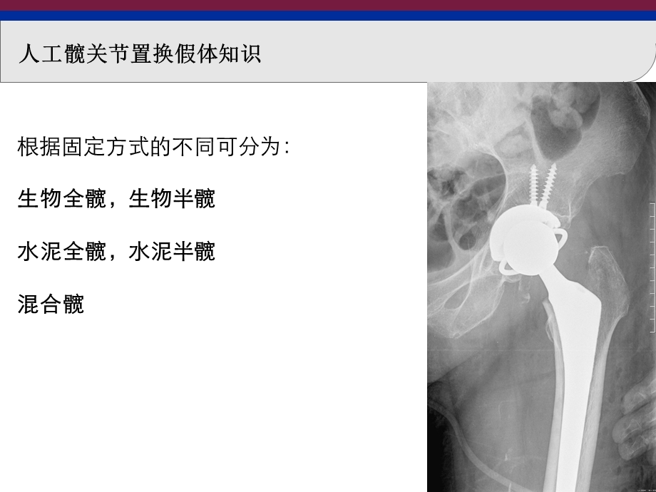 人工髋关节置换假体知识.ppt_第3页