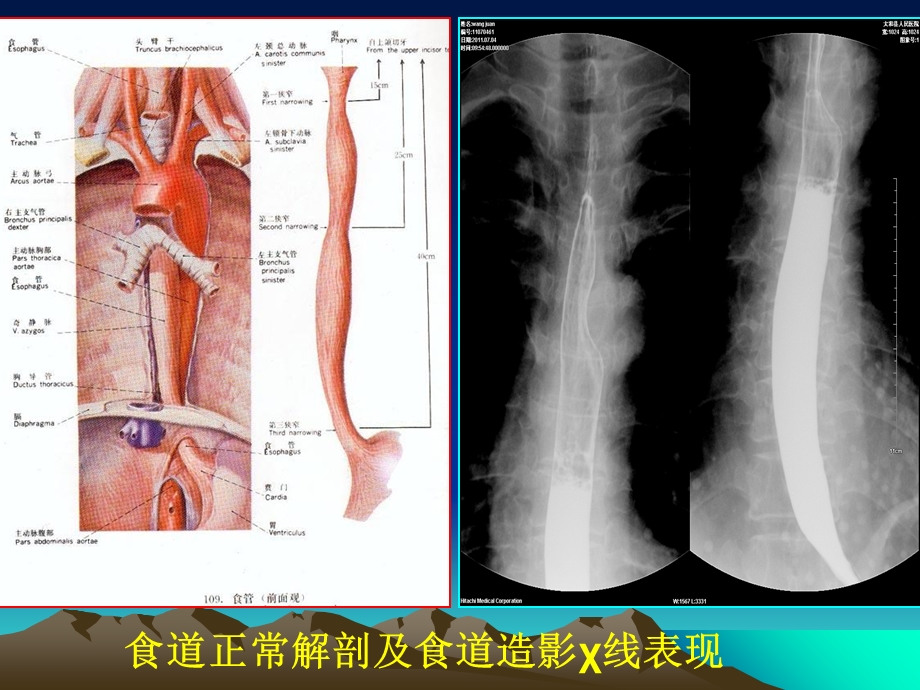 中晚期食道癌的X线诊断及内支架植入治疗.ppt_第2页