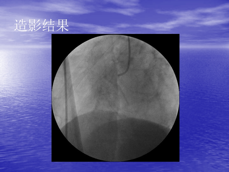 多支病变PCI一例.ppt_第3页