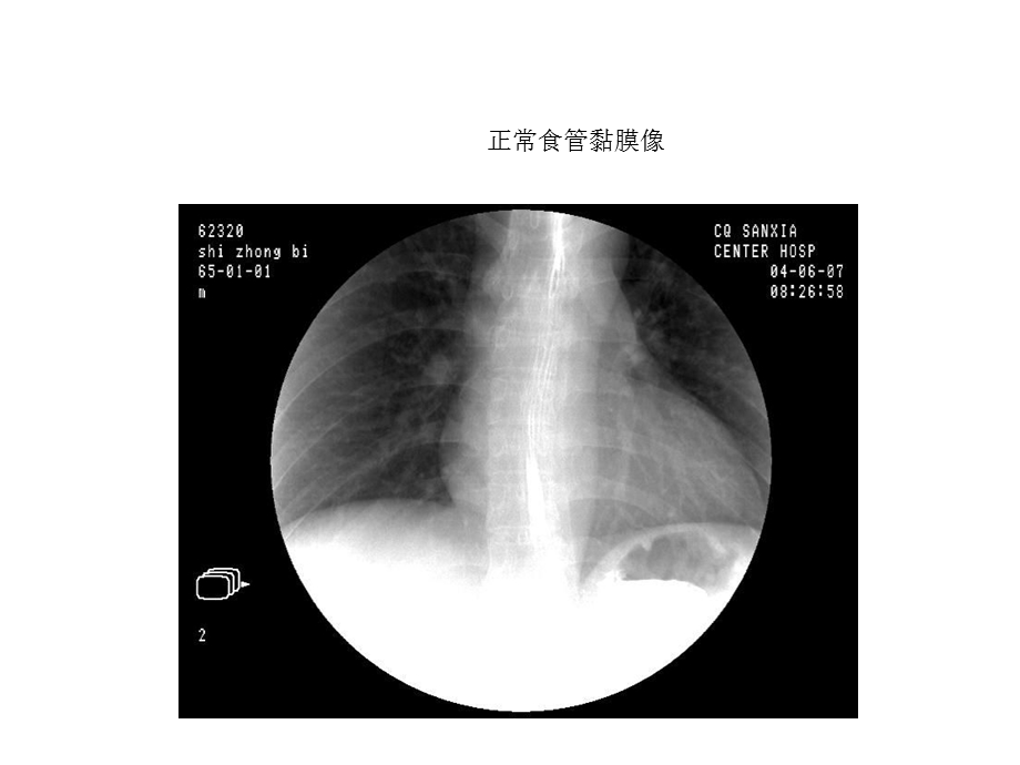 全套消化道钡餐图片.ppt_第2页