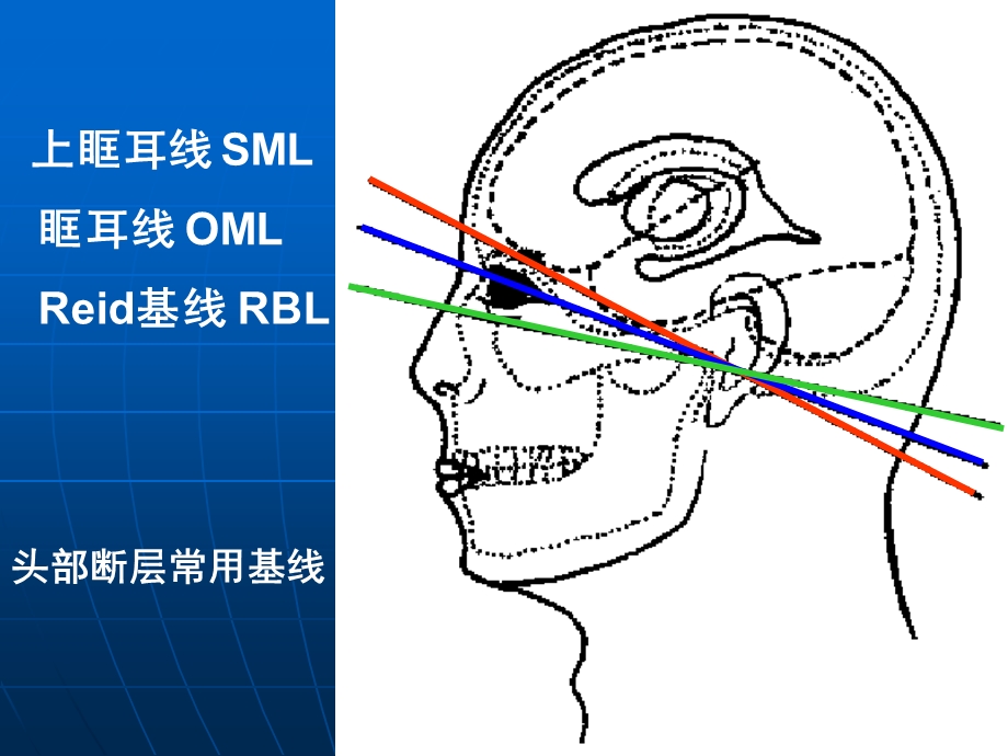 头颅CT解剖及诊断.ppt_第3页