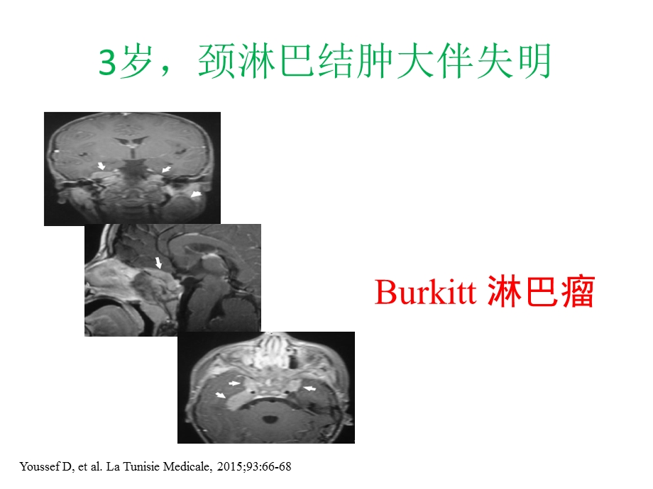 小儿颈部淋巴结.ppt_第2页