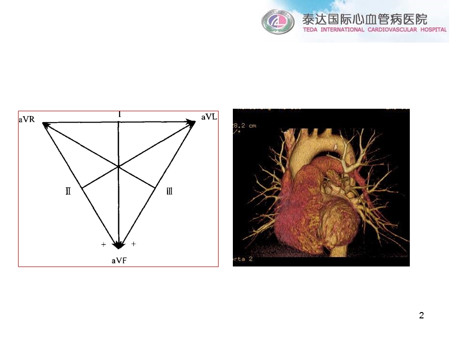 流出道室早消融体表心电图提供的决策.ppt_第2页