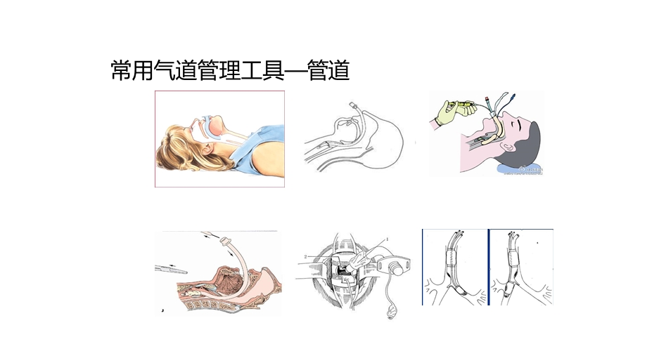 可视喉镜新技术.ppt_第3页