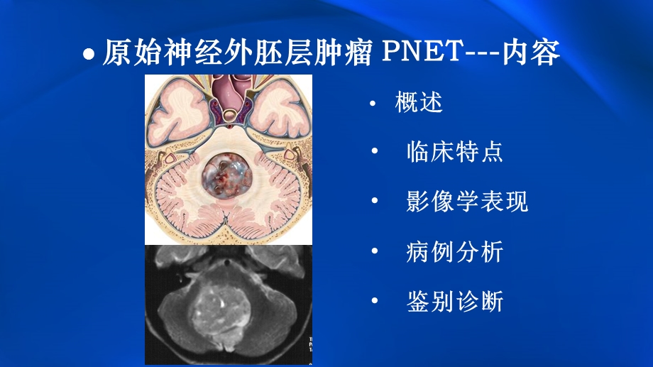 原始神经外胚层肿瘤.ppt_第2页