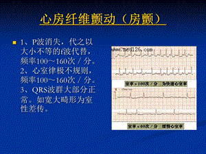 几种常见心电图表现.ppt