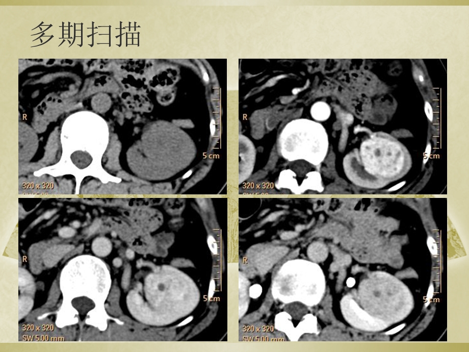 教学读片肾脏富血供肿瘤CT诊断.ppt_第3页