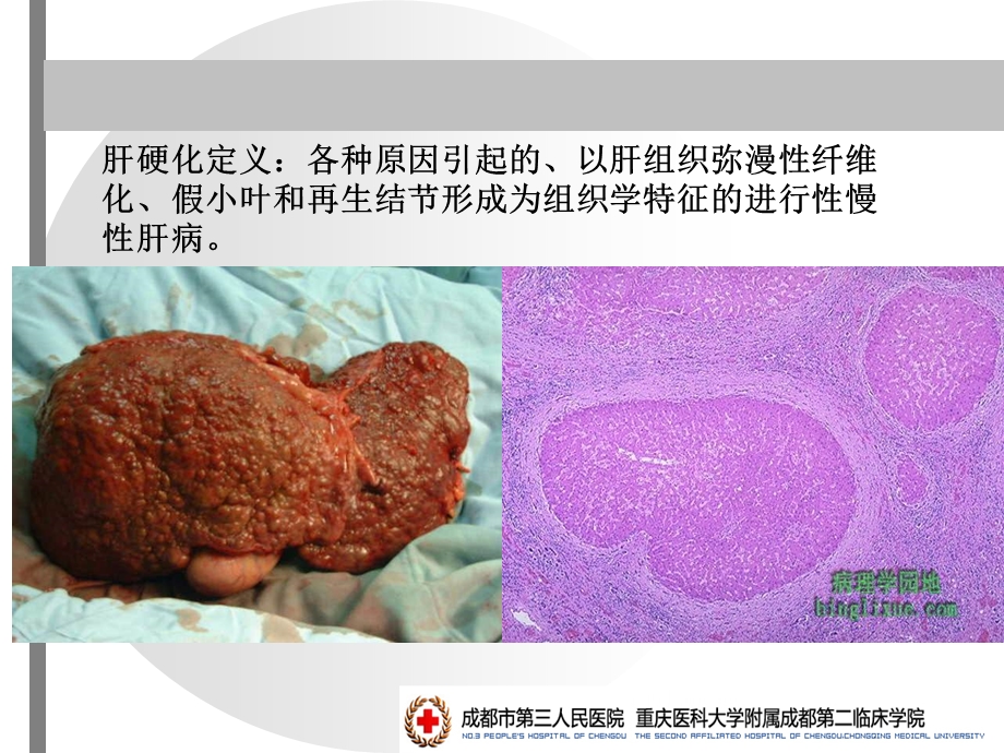 内科学-肝硬化.ppt_第2页