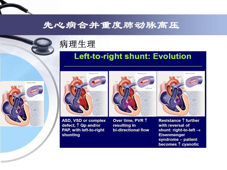 先心病并重度肺动脉高压治疗单中心经验.ppt_第3页