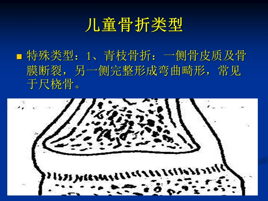 小儿骨折特点讲义.ppt_第3页