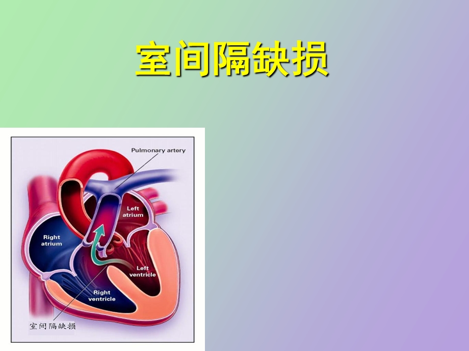 先心病室间隔缺损.ppt_第1页