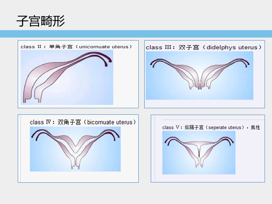 子宫畸形超声诊断标准及思路.ppt_第2页