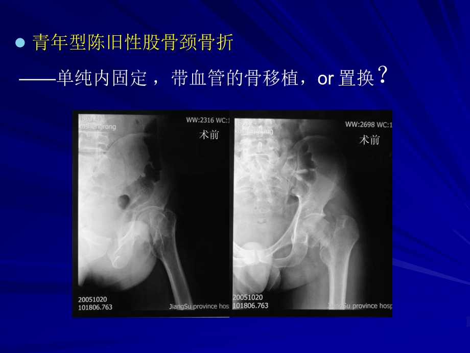 吻合血管游离腓骨移植术治疗股骨颈陈旧骨折及骨不连.ppt_第2页