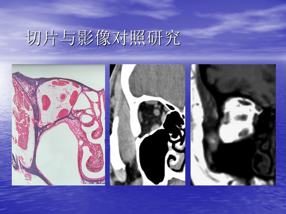 头颈部肿瘤影像诊断与鉴别梁晨阳.ppt_第3页