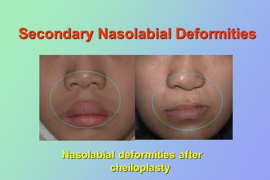 先天性唇、面裂和腭裂双语版.ppt_第2页