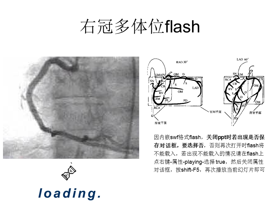 冠脉造影读片入门新.ppt_第3页