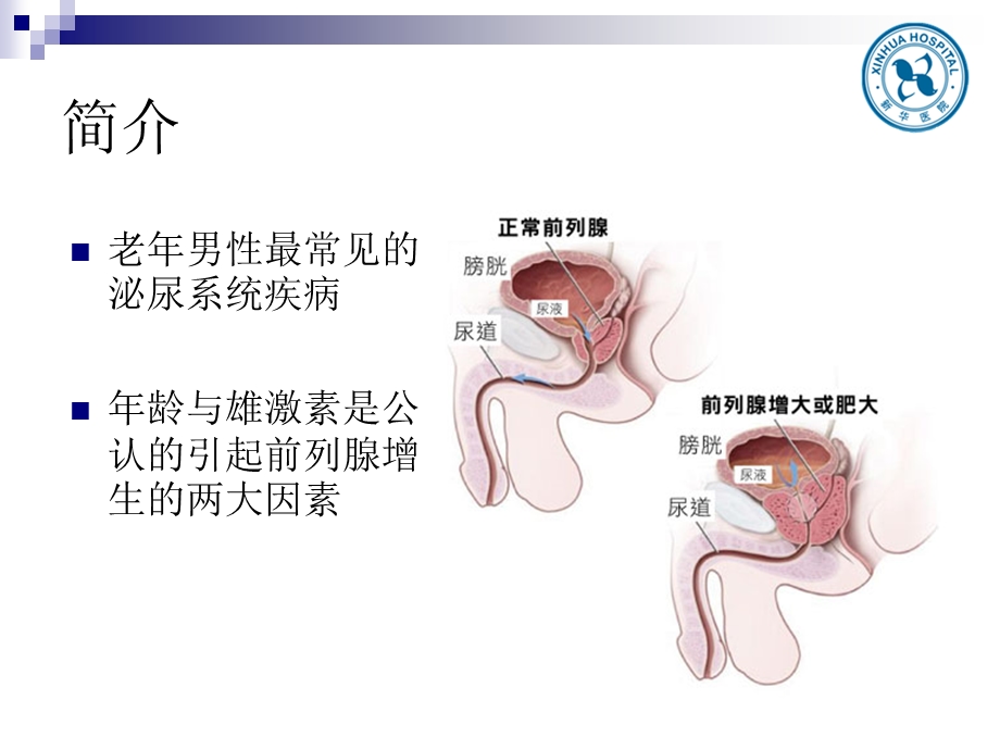 前列腺增生教学查房.ppt_第2页