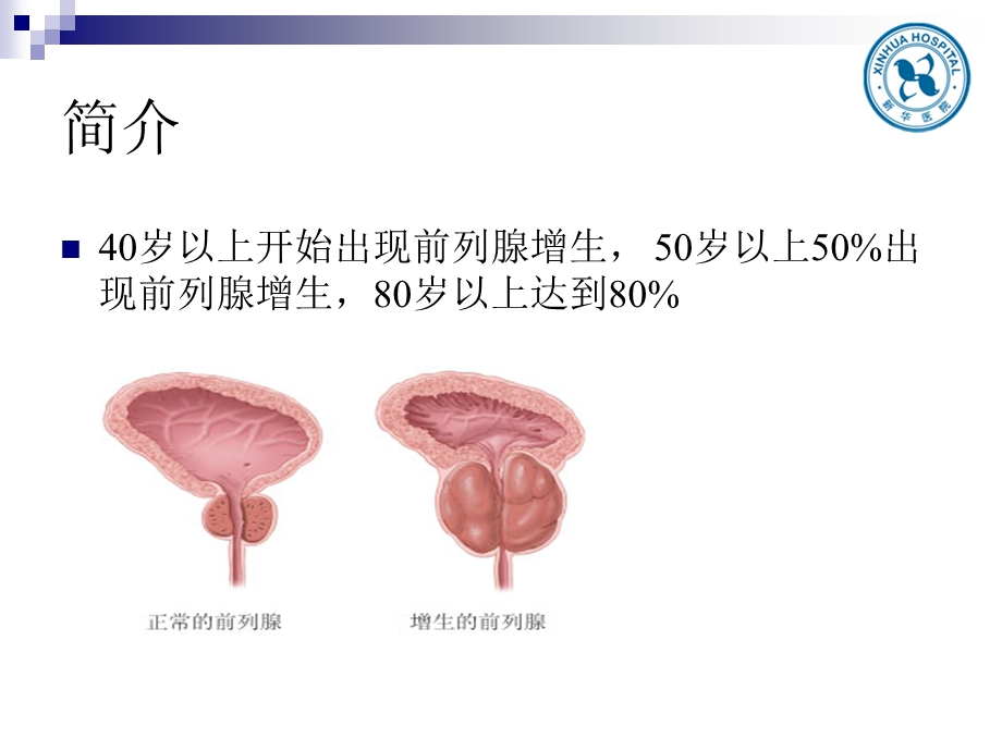 前列腺增生教学查房.ppt_第3页