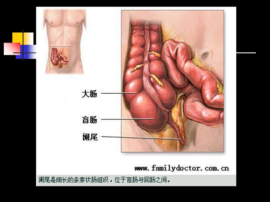 外科护理学阑尾炎病人的护理课件.ppt_第3页