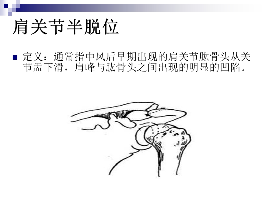 偏瘫患者肩关节常见问题.ppt_第2页