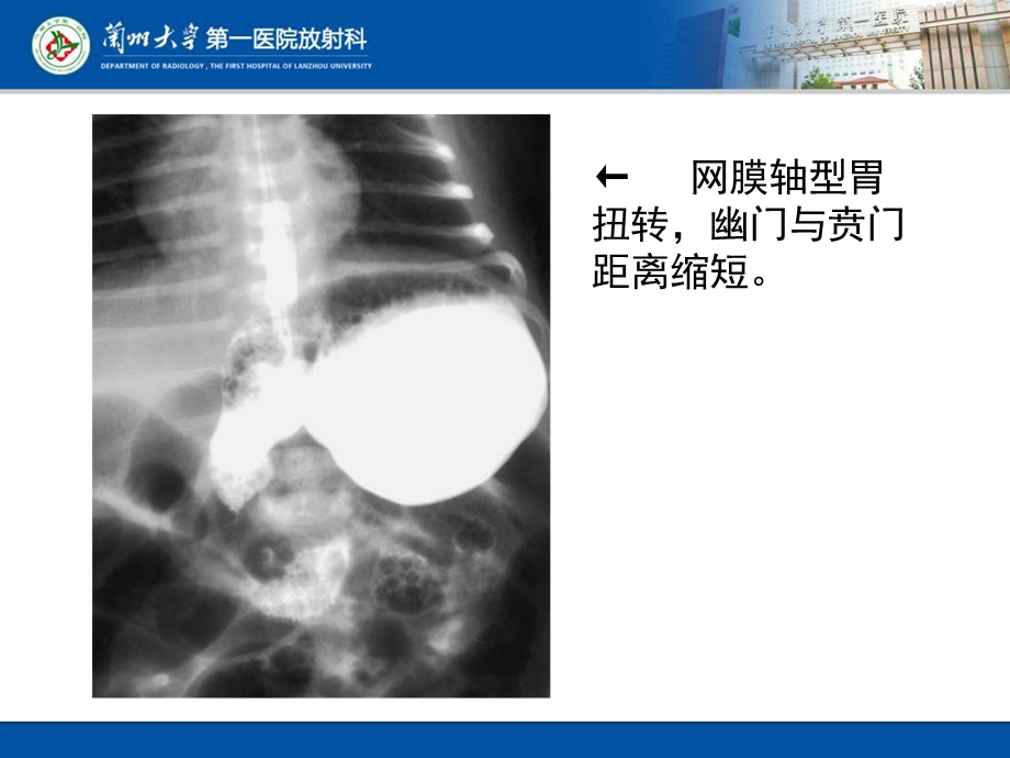 小儿常见消化道畸形影像表现.ppt_第3页