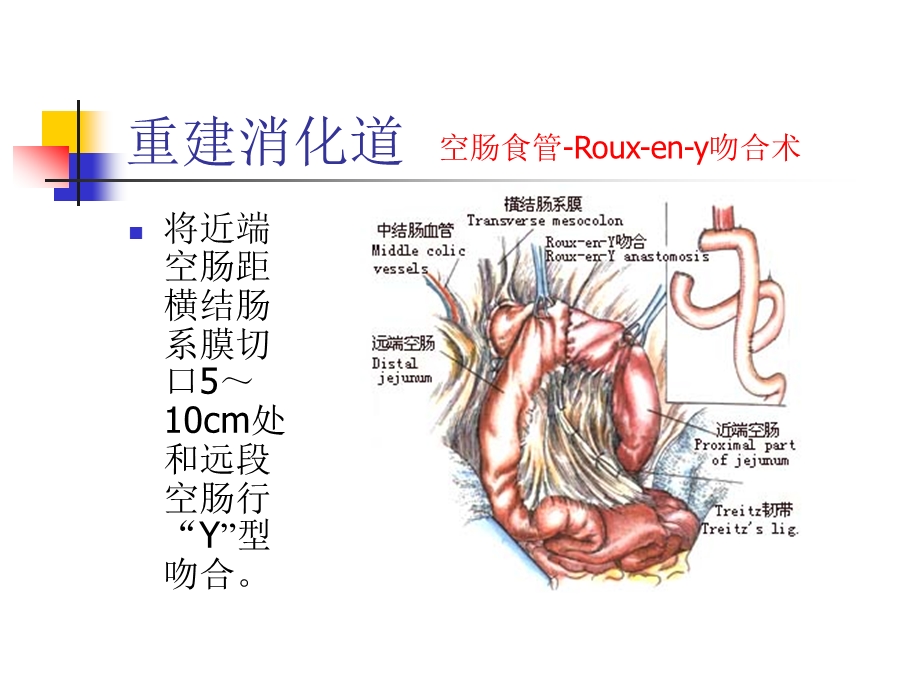 图解全胃切除术三.ppt_第2页