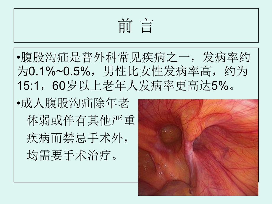 完全腹膜外补片植入术.ppt_第2页