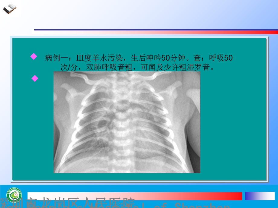 新生儿胸片基本读片(共五例).ppt_第2页