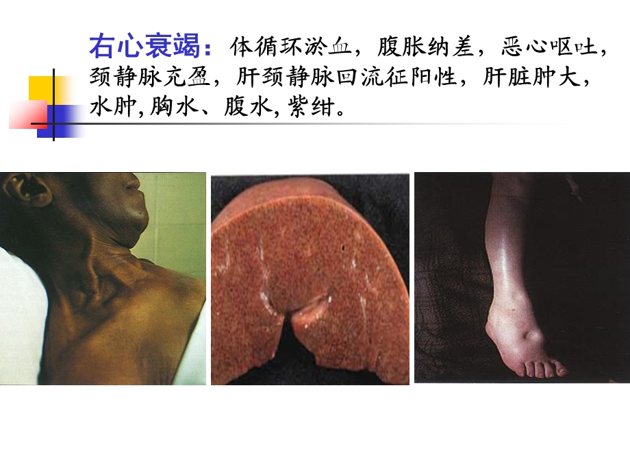 心衰的液体管理.ppt_第3页