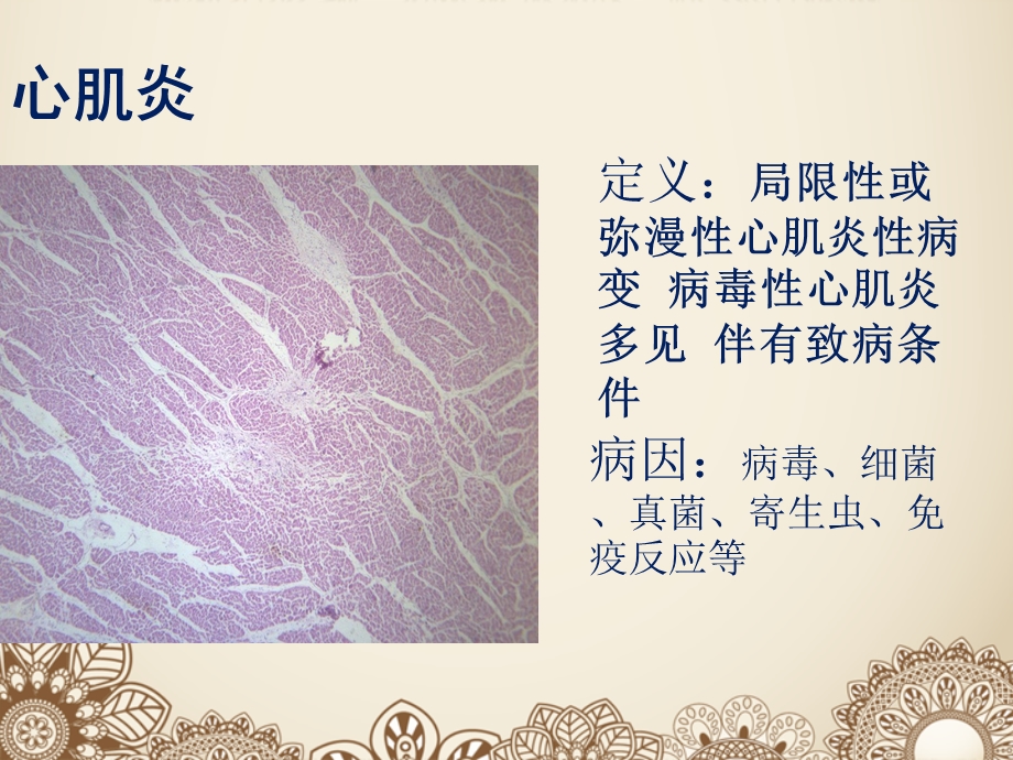 小儿病毒性心肌炎(重症).ppt_第2页