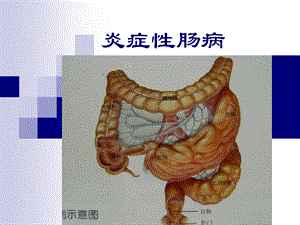 炎症性肠病(本科内科护理临床部分).ppt