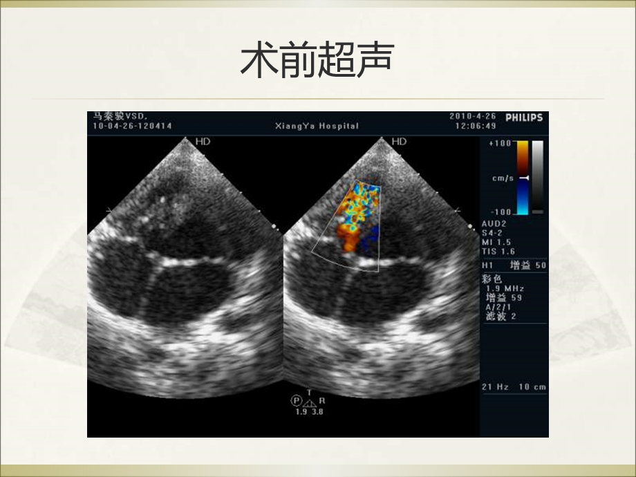 室缺封堵术后残余分流追踪观察1例.ppt_第3页