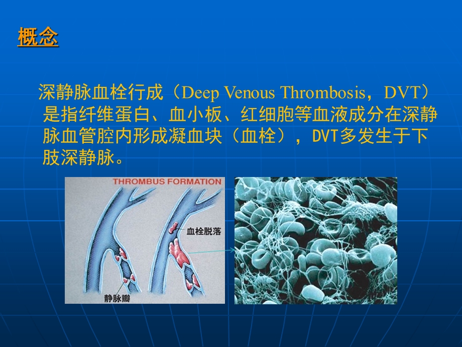 深静脉血栓诊治.ppt_第2页