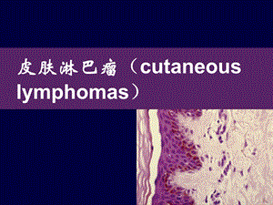 皮肤淋巴瘤诊断和治疗进展.ppt