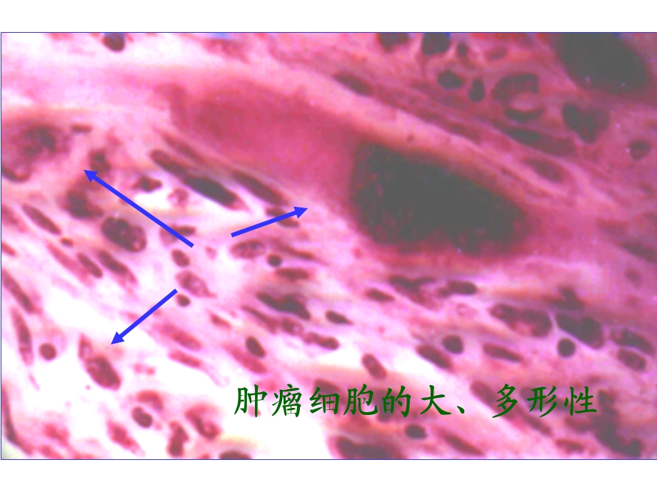 肿瘤细胞的异型性.ppt_第2页