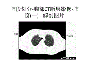 胸部CT肺段划分.ppt