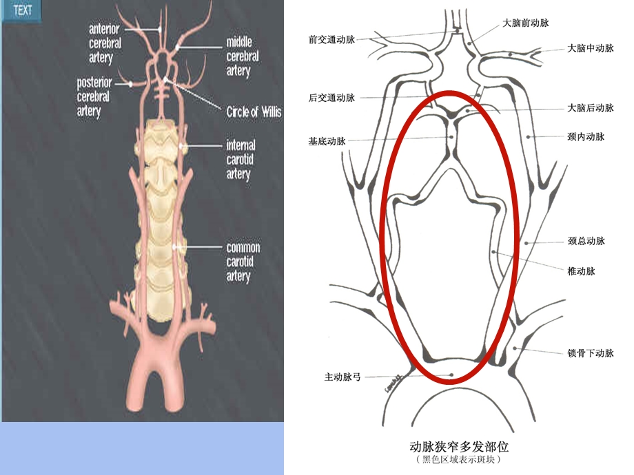 眩晕与后循环缺血.ppt_第3页