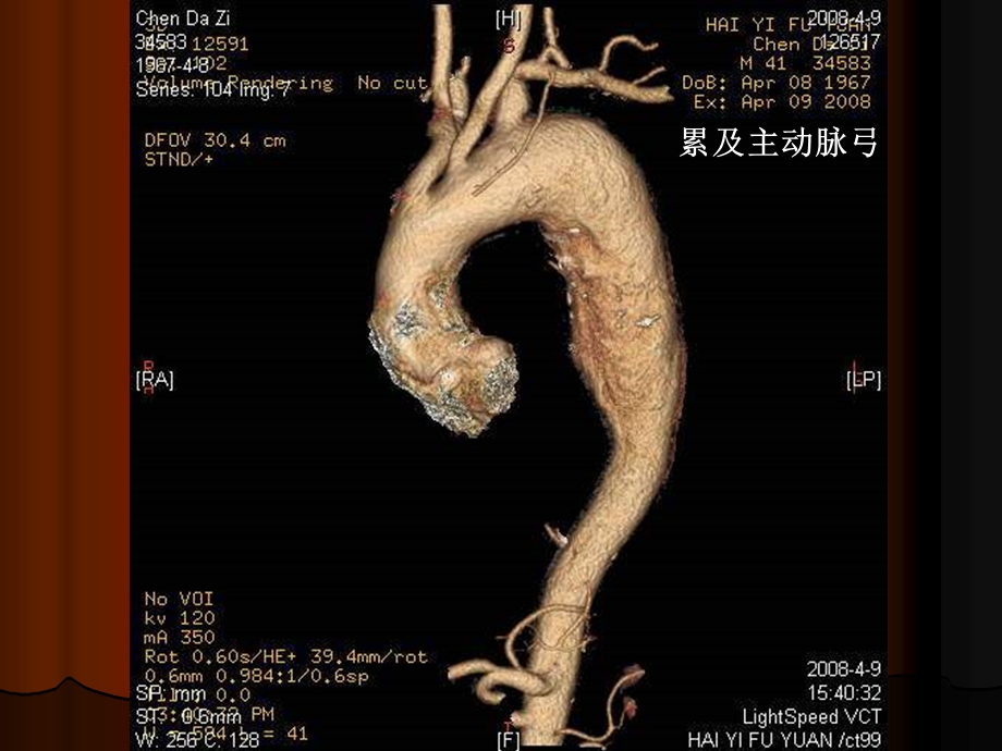 杂交手术治疗邻近或累及主动脉弓的胸主动脉扩张疾病课件.ppt_第3页