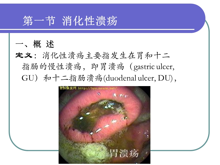 消化性溃疡的药物治疗.ppt_第3页