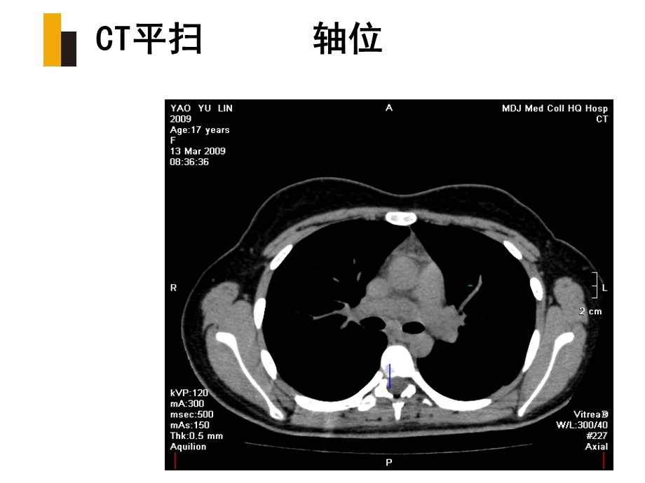 纵隔淋巴结节结核.ppt_第3页