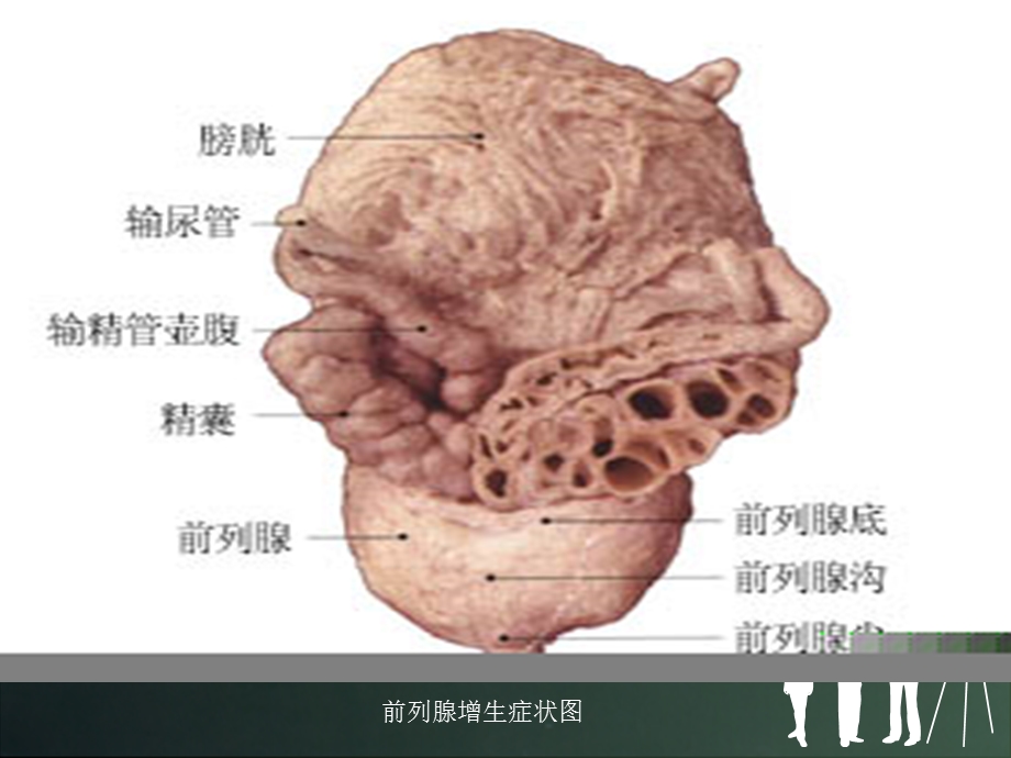 经尿道前列腺电切术后的护理.ppt_第3页