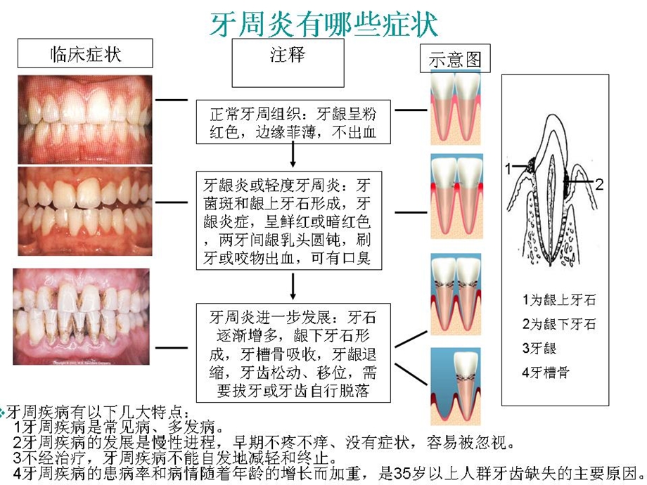 牙周炎的分类及临床表现.ppt_第2页