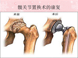 髋关节置换术的康.ppt