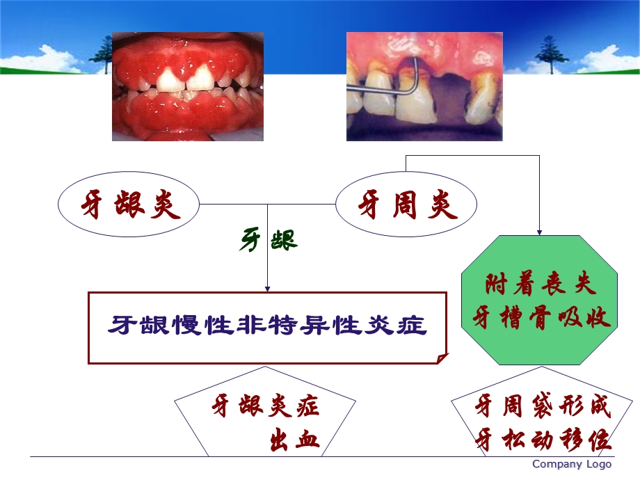 牙周病学牙周病的主要症状和临床病理.ppt_第2页