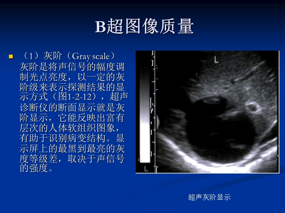 解读B超报告基础知识.ppt_第3页