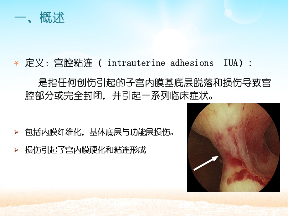 重度宫腔粘连的诊治.ppt_第2页