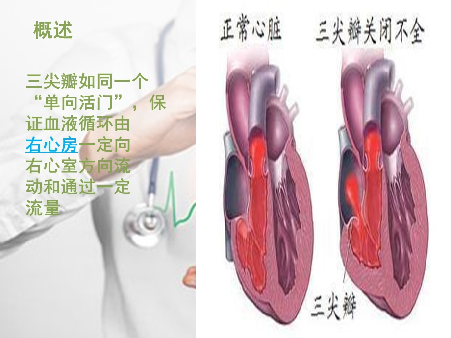 胸腔镜三尖瓣置换术后护理查房.ppt_第3页