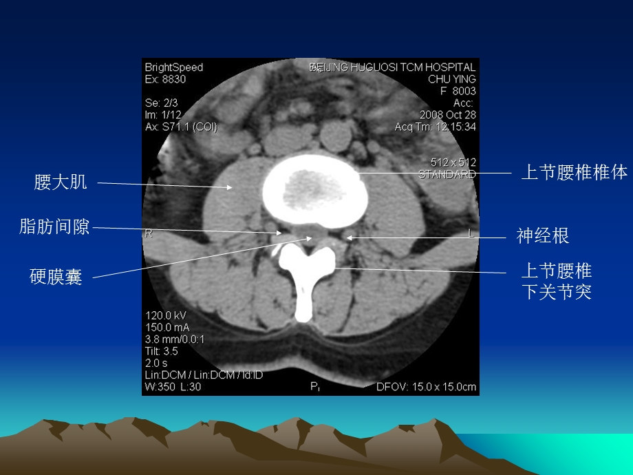 腰椎CT诊断大全(新手实用).ppt_第3页