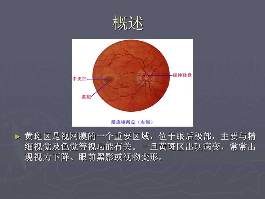 老年性黄斑变性.ppt_第2页